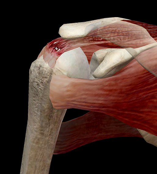 Supraspinatus tear clearance